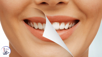 بلیچینگ دندان